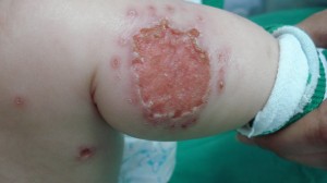 Skin Ulcer