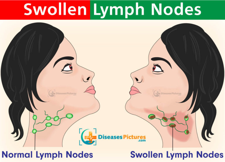 back of neck swollen lymph nodes