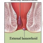 Hemorrhoid
