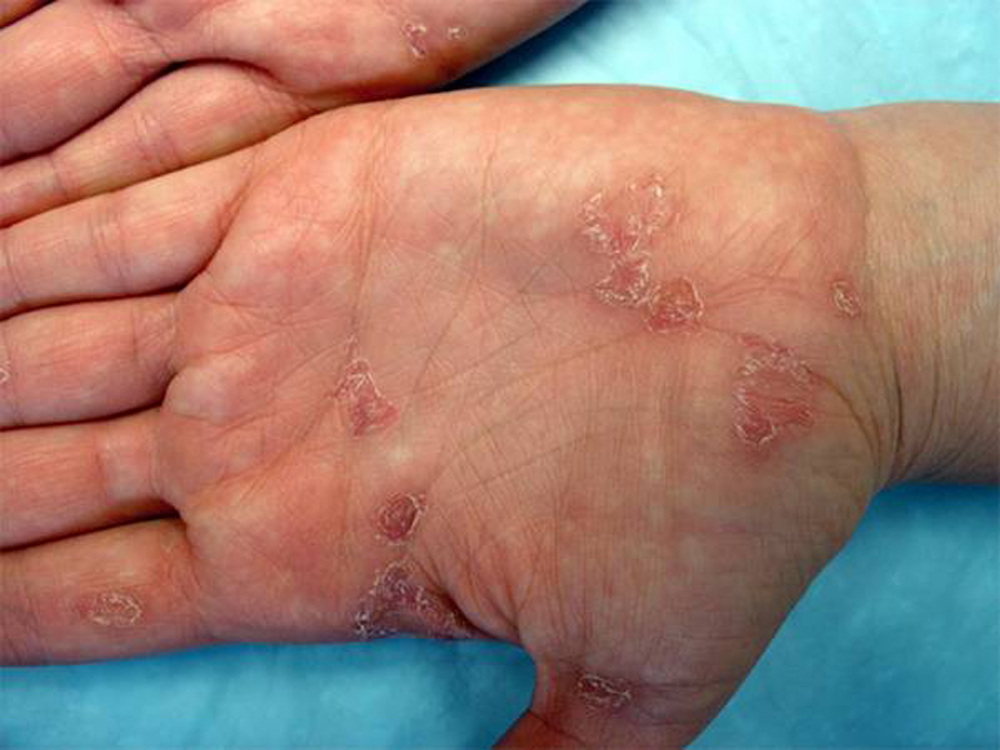 Syphilis Causes Symptoms Rash Treatment Pictures Diagnoses