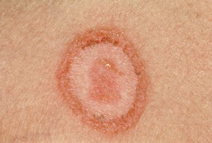 Ringworm Fungal Infections