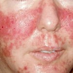 Skin rashes