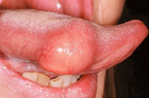 Swollen Tongue