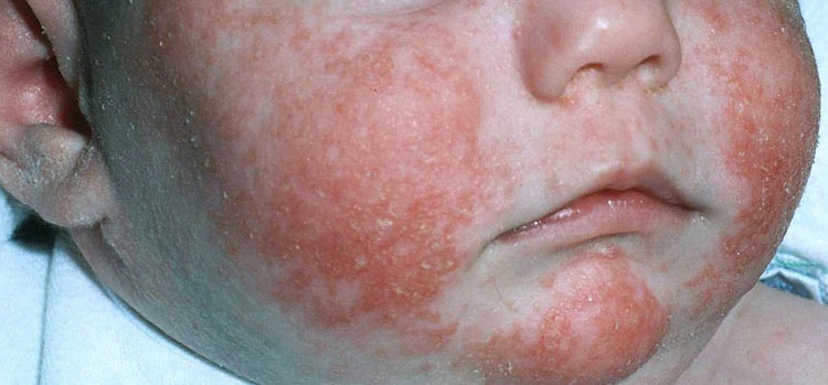 Baby Rashes Causes Symptoms Pictures Types Treatment Prevention
