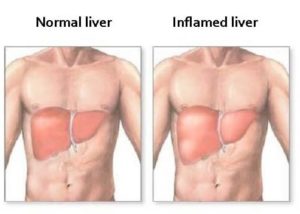 Inflamed Liver
