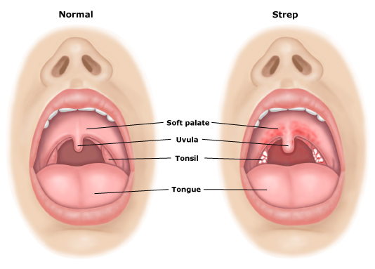 Strep Throat Symptoms Causes Treatment Pictures Home Remedies 5056