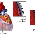 Pericarditis