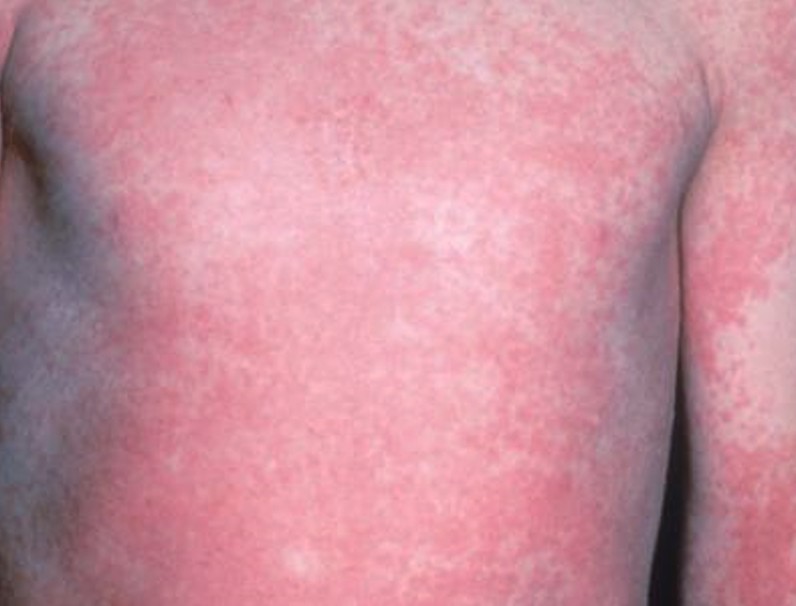 Scarlet Fever Symptoms Pictures Causes Tests Treatment Prevention Healthmd