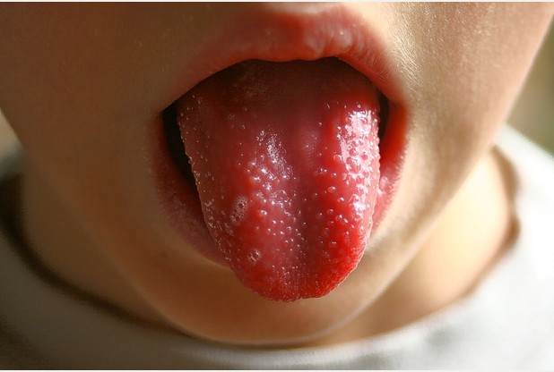 Scarlet Fever - Symptoms, Pictures, Causes, Tests, Treatment