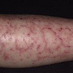 Asteatotic Eczema