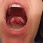 Uvula Swollen