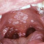 Chlamydia in throat