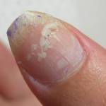 Peeling Nails