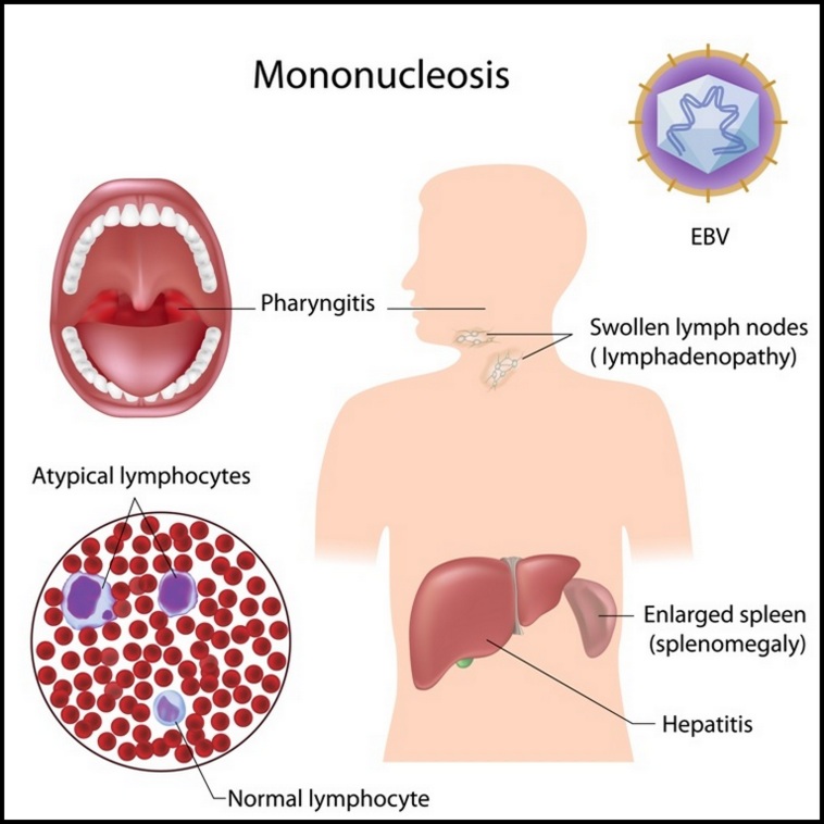 mononucleosis definition
