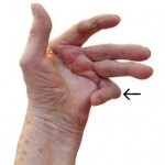Arthritis In Hands