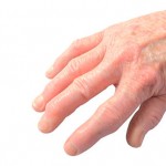 Arthritis In Hands