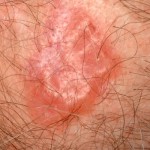 Skin Cancer On Scalp