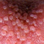 Bumps on back of tongue