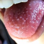 Bumps on back of tongue