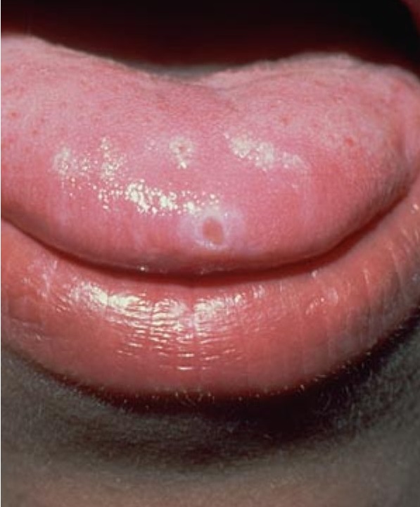 Pimple On Tongue Symptoms Causes Remedies Tip White Under Side