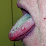 Pimple on Tongue