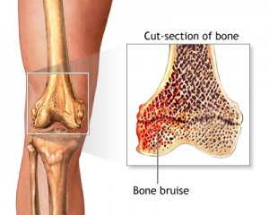 Bone Bruise