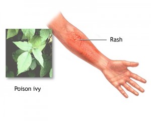 Poison Oak Rash