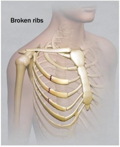 broken ribs