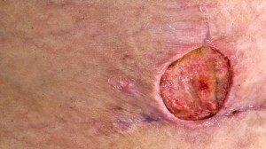 mrsa skin infection