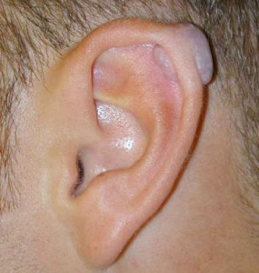 Cartilage Piercing Bump