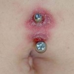 Piercing Infection