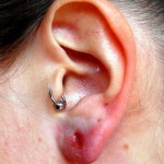 Piercing Infection