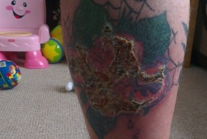 Tattoo infection diseases