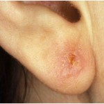 infected ear piercing