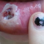 Infected Lip Piercing