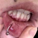 Infected Lip Piercing