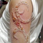Infected Tattoo