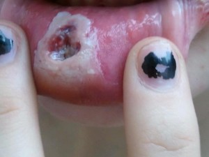piercing infection