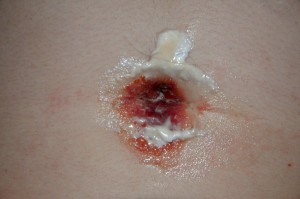 piercing infection