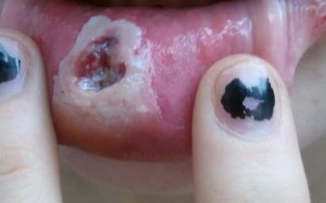 Body Piercing Infection