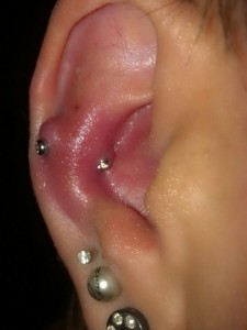 Body Piercing Infection