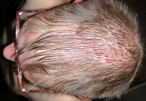 Itchy scalp
