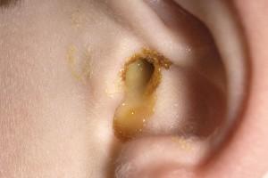 Ear Discharge