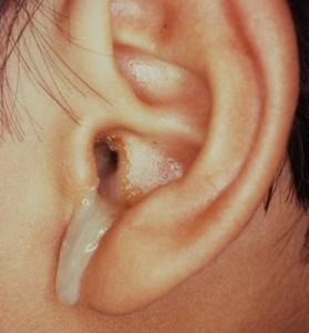 Ear Discharge