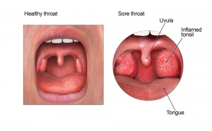 Sore Throat