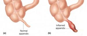 Appendix pain