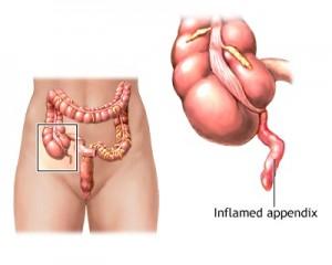 Appendix pain