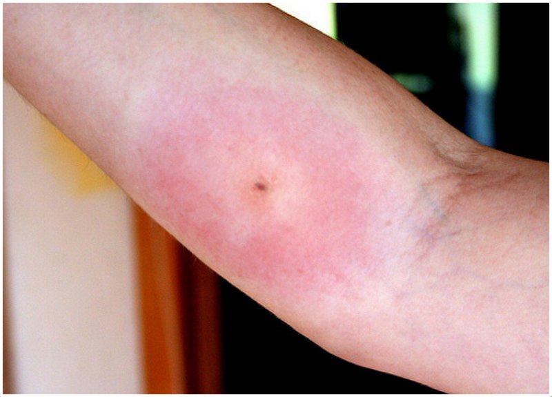Wolf Spider Bite Symptoms, Treatment, Pictures, Prevention, Remedy Health MD