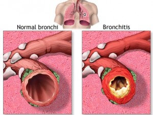 home remedies for bronchitis