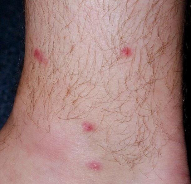Red Dots On Legs